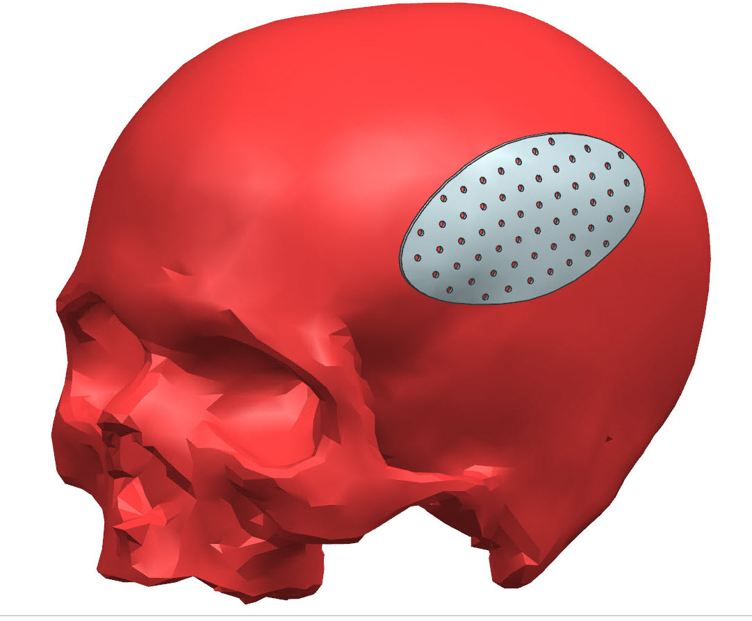 Cranial Implant NX Convergent Modelling_cropped.jpg