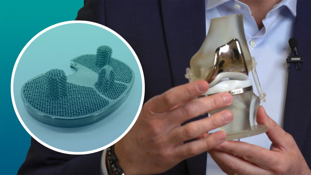 Man holding a knee implant designed with additive manufacturing