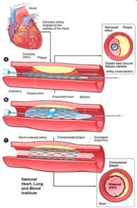 Planar Titanium Stent Design using NX Simulation