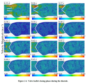 Saving Lives: CFD Simulation of a Mechanical Heart Valve