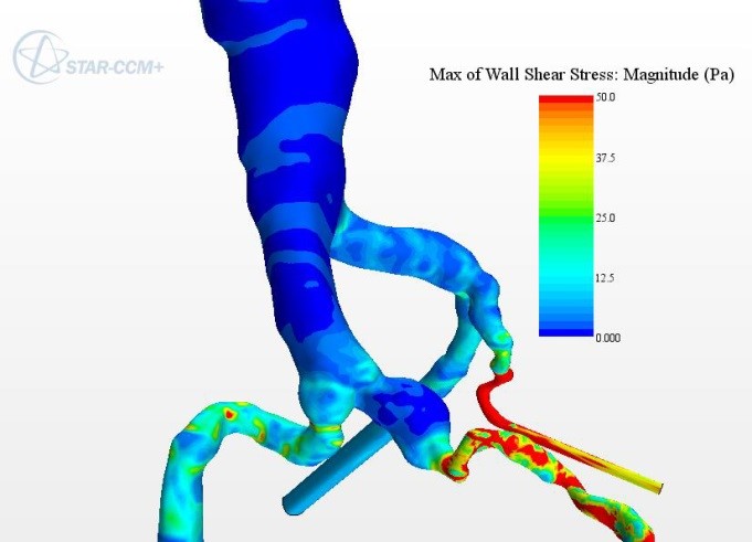 CFD model of abdominal aortic aneurysm for development of medical device