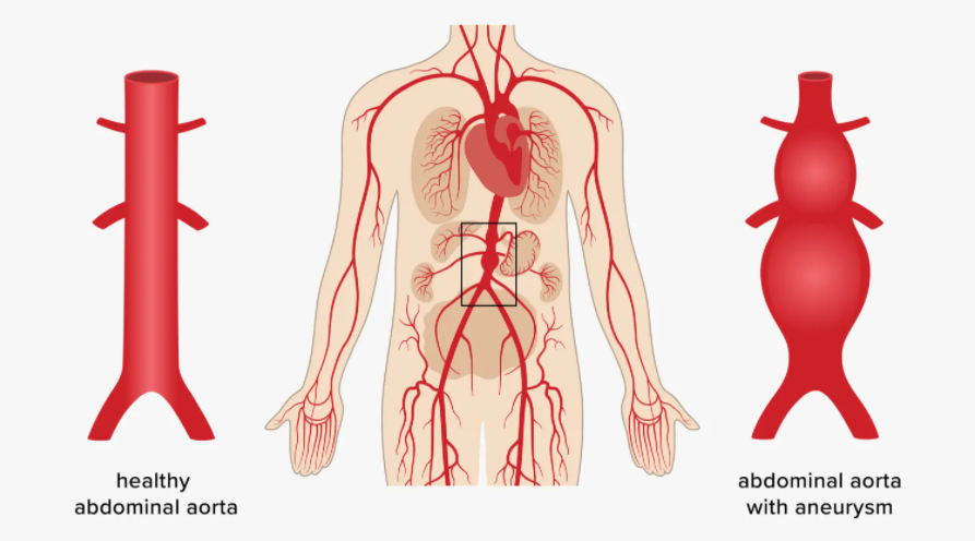 Description of the condition of abdominal aortic aneurysm